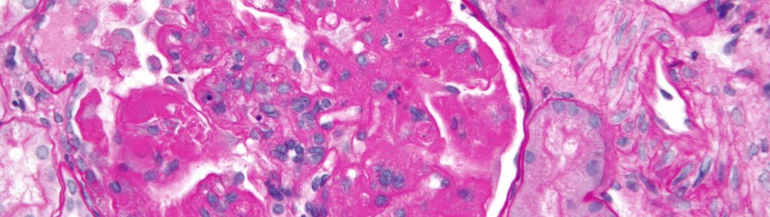 Lupus nephritis