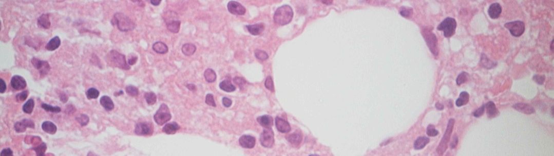 histopathology of the bone marrow