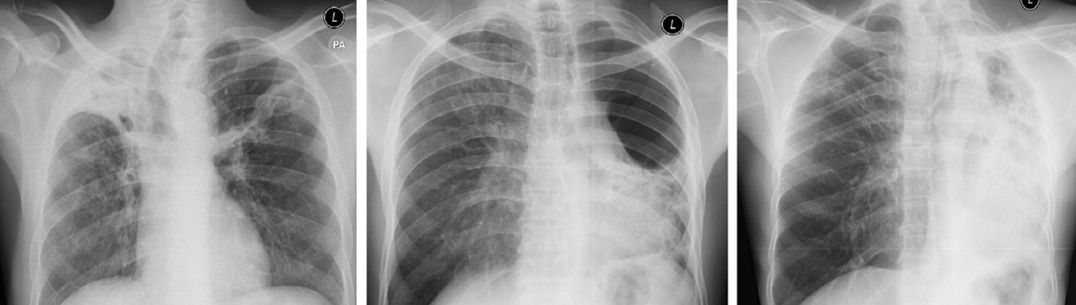 A picture showing chest x-rays