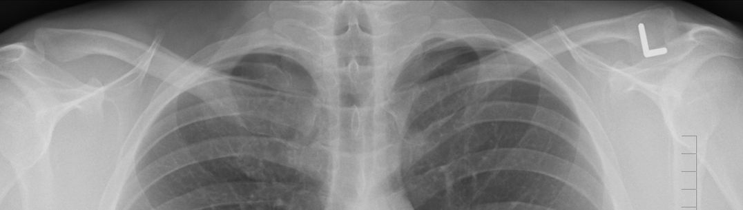 An image of a lung x-ray