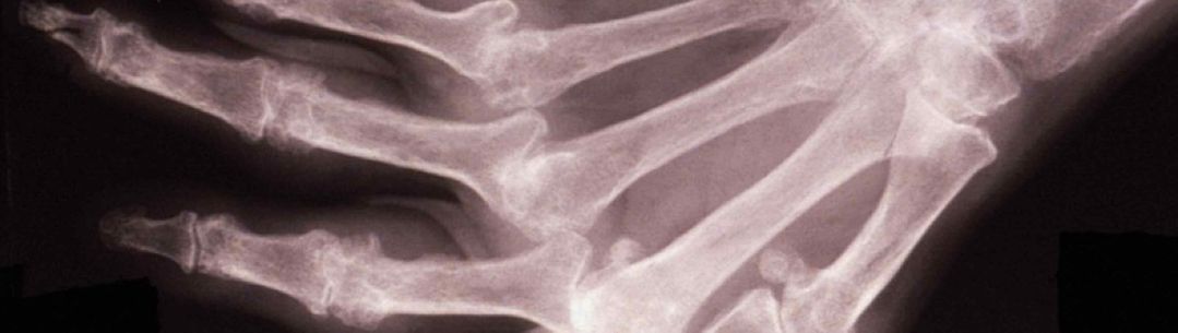 Inflammatory conditions