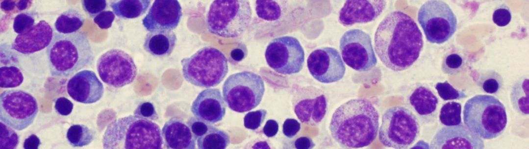 Multiple Myeloma