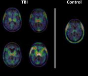 Chronic inflammation after TB