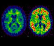 Amyloid imaging