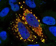 Fluorescent image -TAF15 protein forming bubbles filled with RNA, that assemble around the cell nucleus