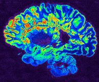 Coloured MRI scan of human brain