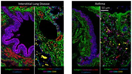 Interstitial lung disease and asthma