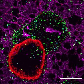 Accumulation of inflammatory cells  close to the airways