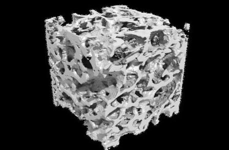 Microtomographic reconstruction of a human femoral bone sample