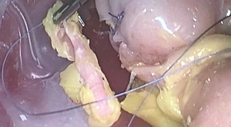 Laparoscopic appendicectomy