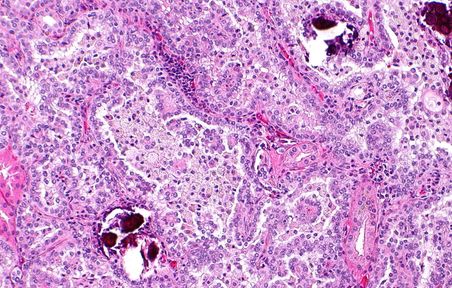 Renal pathology