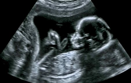 Baby ultrasound scan image