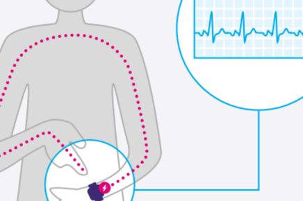 Infographic of ECG monitoring via smartwatch