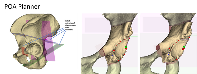 Peri Acetabular Osteotomy is a procedure to realign the cup of the hip to provide better coverage of the femur and reduce the likelihood of hip dislocation. We have created software that allows a surgeon to plan surgery to change the cup orientation and compute measurements to predict coverage.