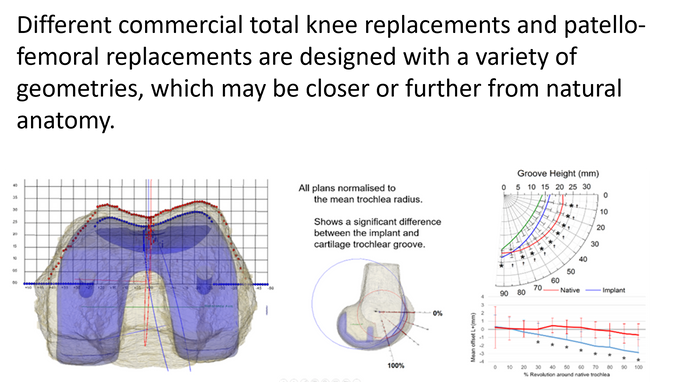 Image of Torch Map Different commercial total knee replacements and patello-femoral replacements are designed with a variety of geometries, which may be closer or further from natural anatomy. We developed software for planning knee surgery that allows the chosen implant to be compared with the native anatomy of the knee. (Simon Harris)
