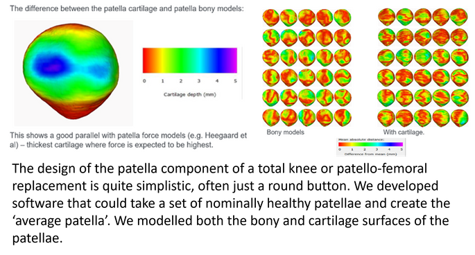 The design of the patella component of a total knee or patello-femoral replacement is quite simplistic, often just a round button. We developed software that could take a set of nominally healthy patellae and create the ‘average patella’.