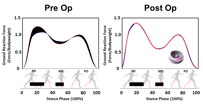 Patients with unilateral hip osteoarthritis demonstrate an asymmetric gait profile pre- op, overloading their non-affected leg. 12 months post- op of a H1 ceramic on ceramic hip resurfacing implant they restore gait function and demonstrate a symmetrical gait profile.