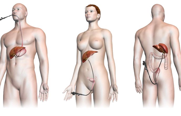 Graphic showing how endoscope is inserted into human body