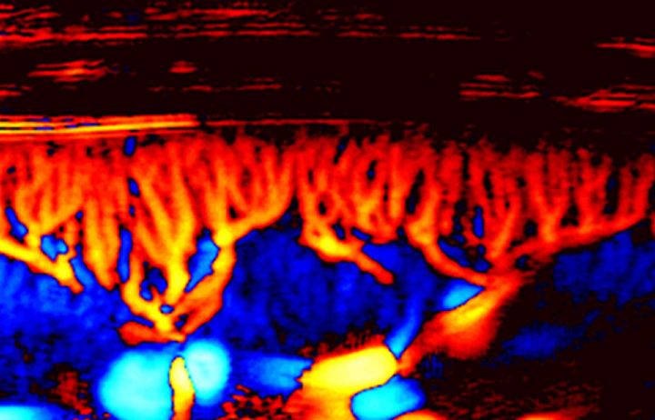 Using Ultrasound to Image Cancer