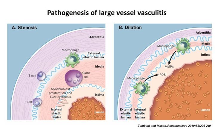Pathogenesis of large vessel vasculitis