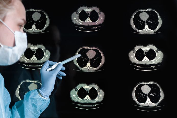 CT scans of lungs