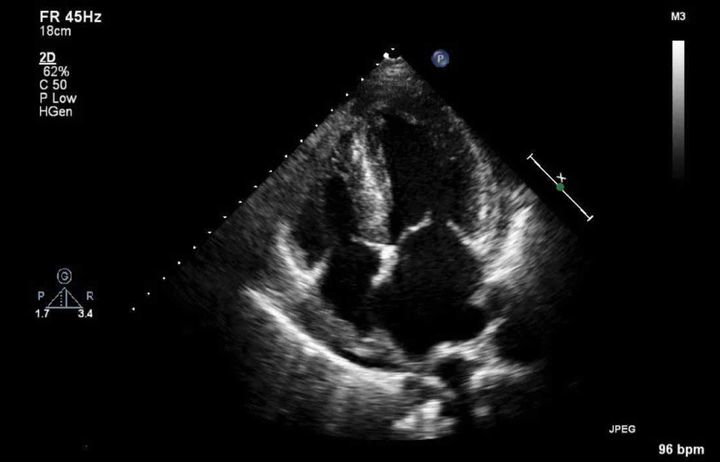 Imaging of heart