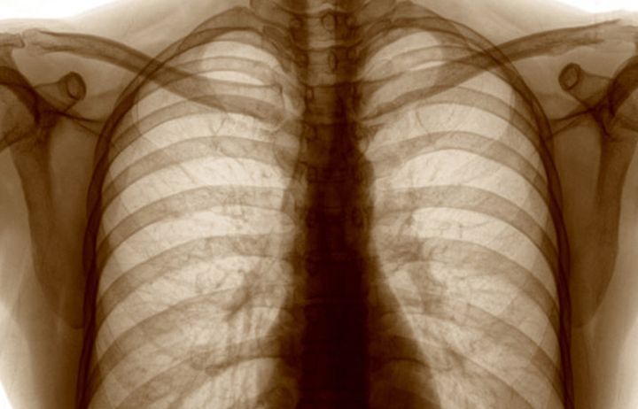 xray of lungs