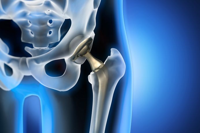 3D illustration of artificial hip joint