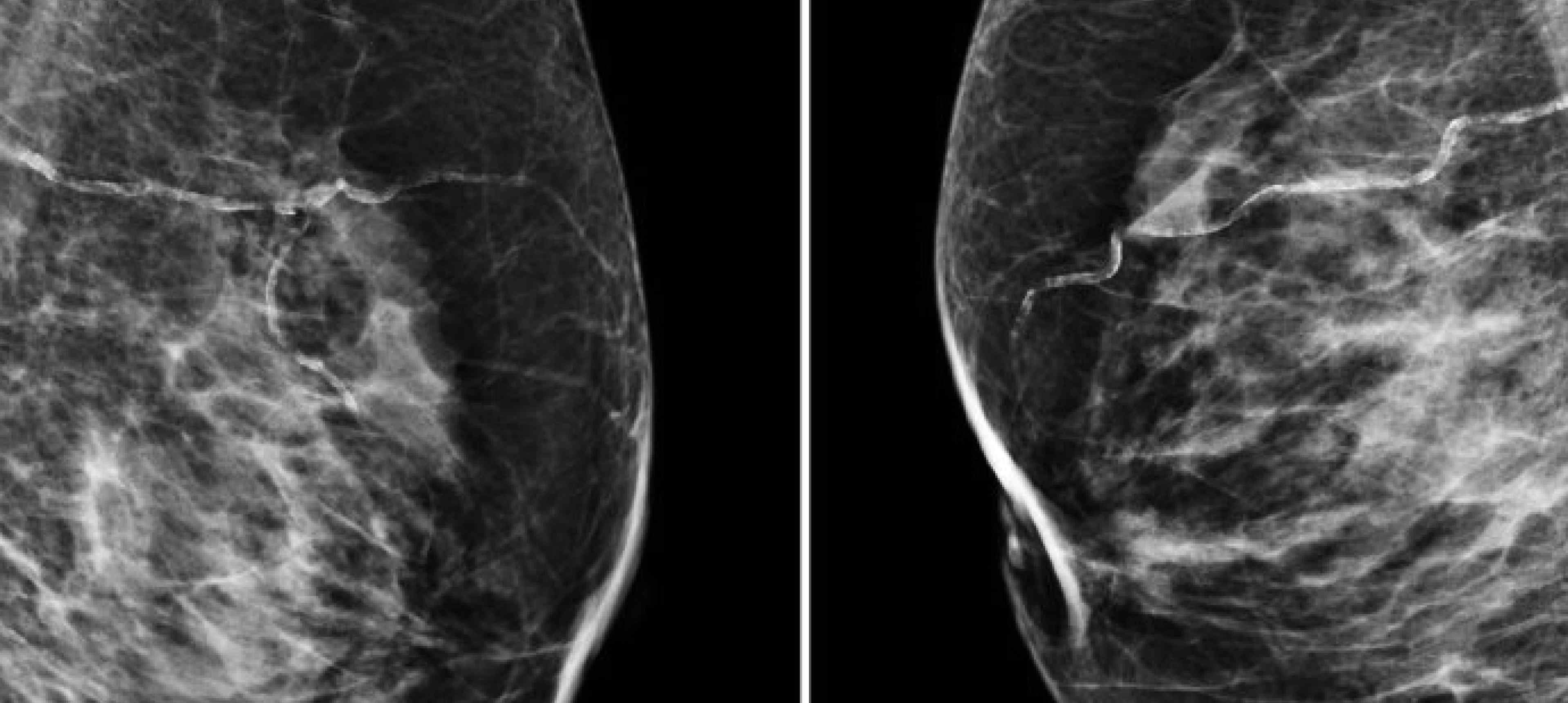 AI and Breast Cancer