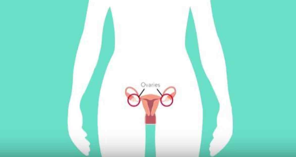 Ovarian cancer diagram