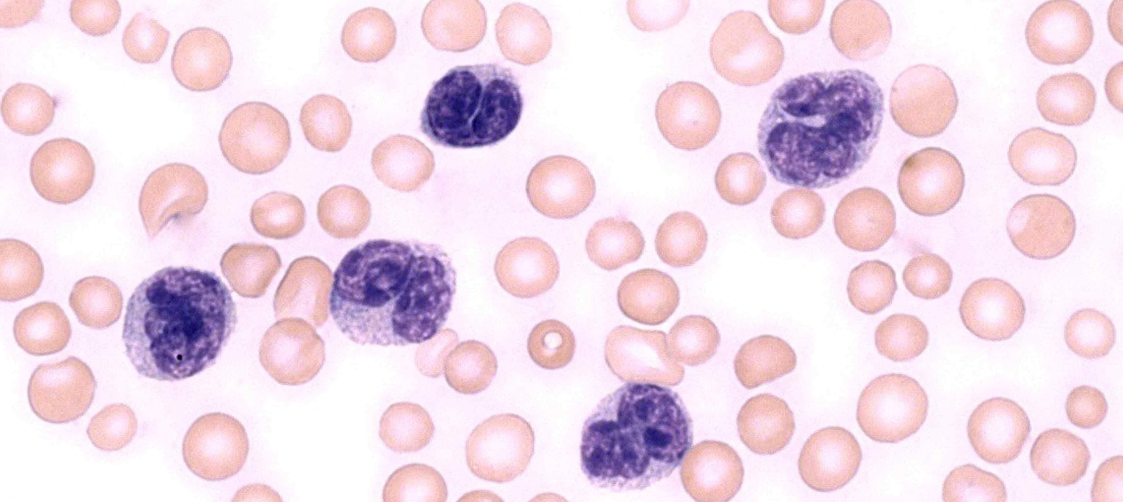 Blood sample of leukemia