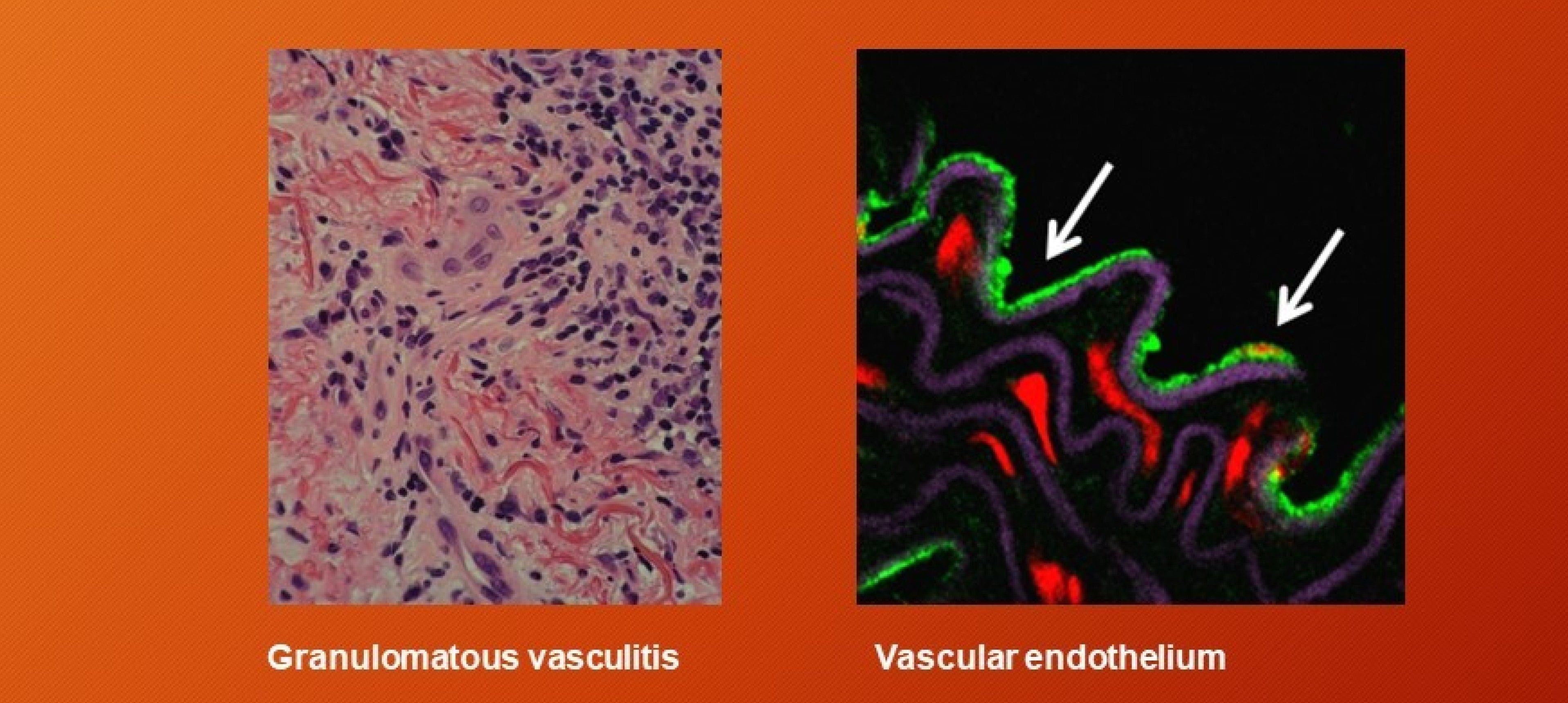 Granulomatous vasculitis