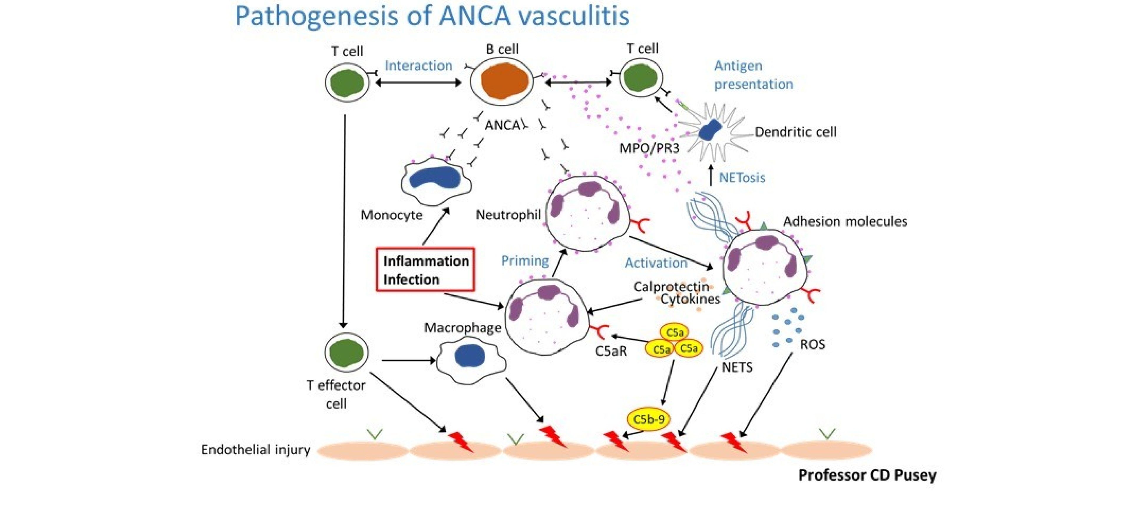Pathogenesis of ANCA vasculitis