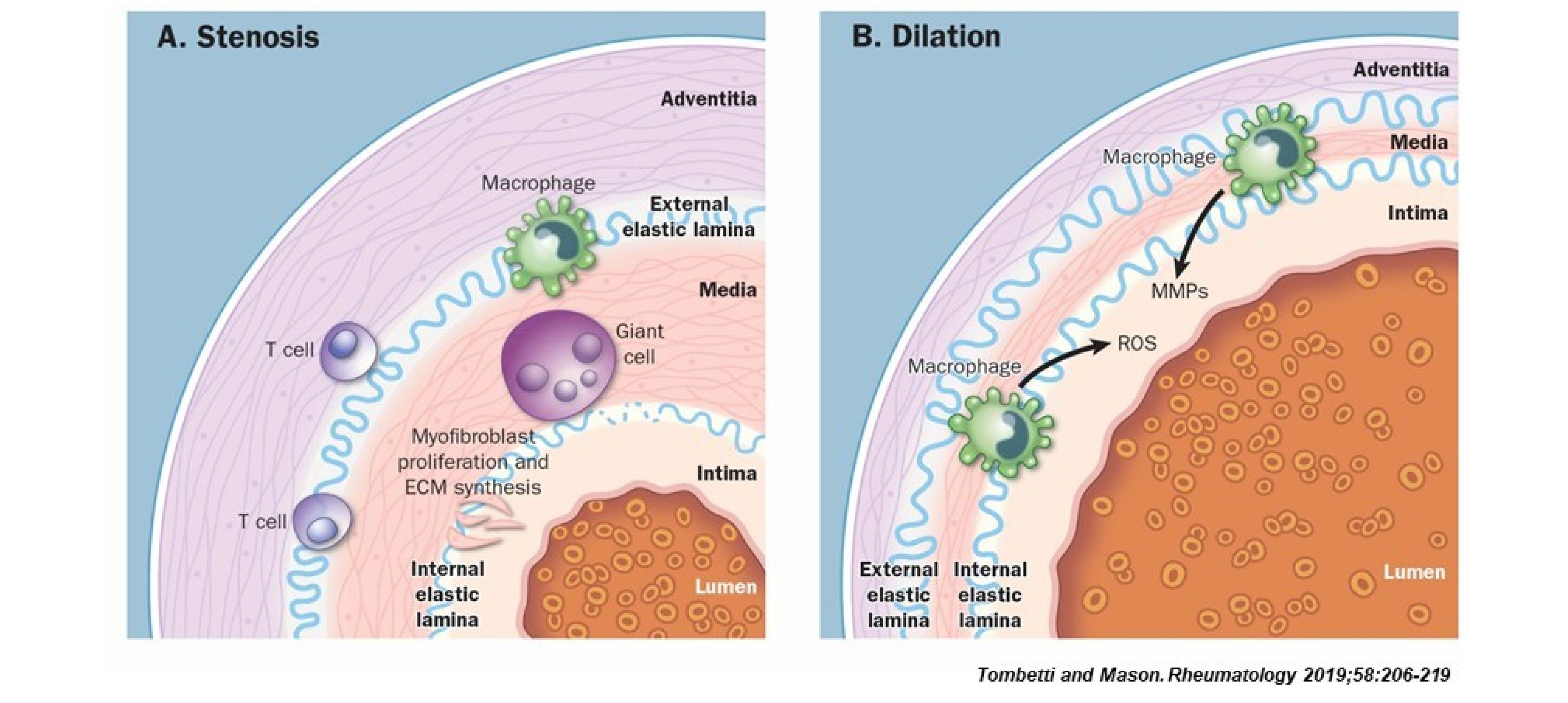 Pathogenesis of large vessel vasculitis