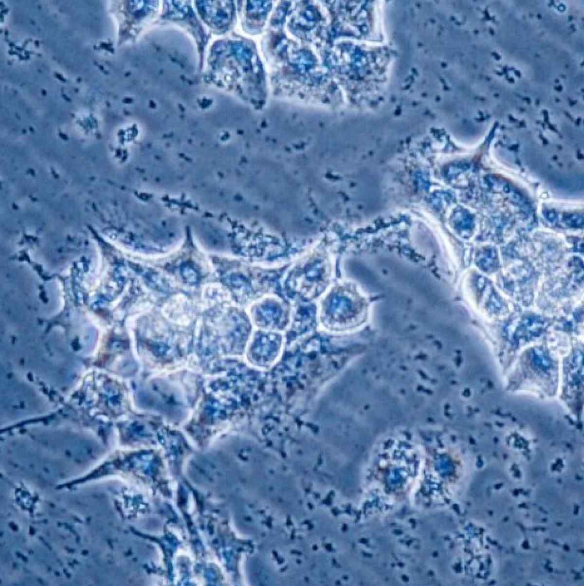 Breast cancer cells