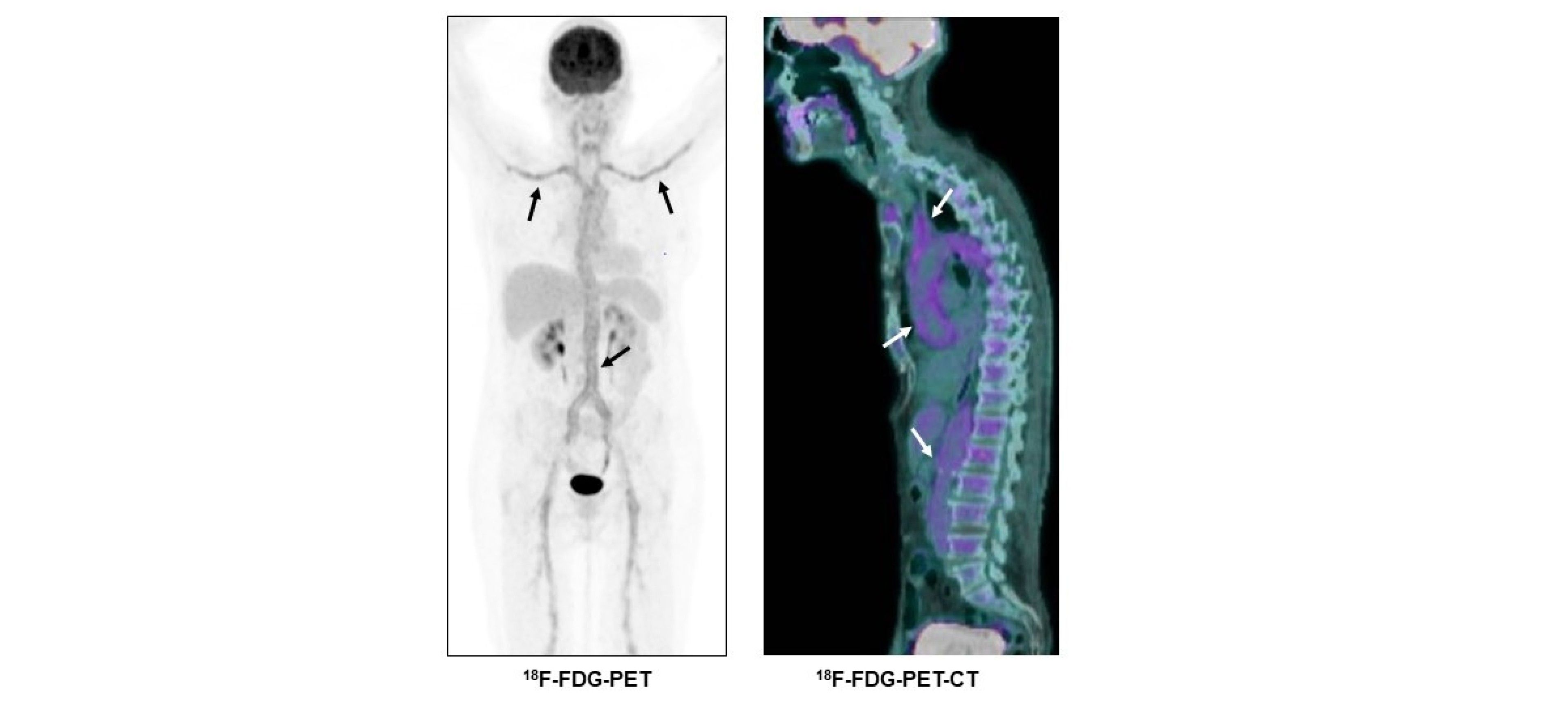 Large vessel vasculitis